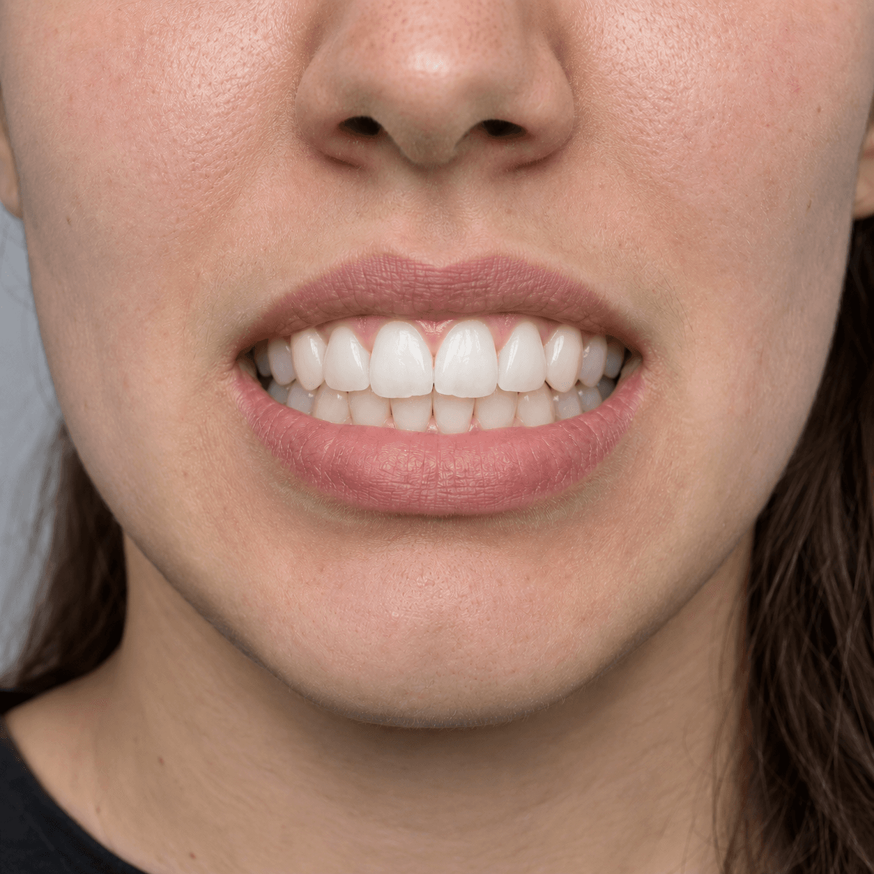 Ortodoncia e Invisalign — después