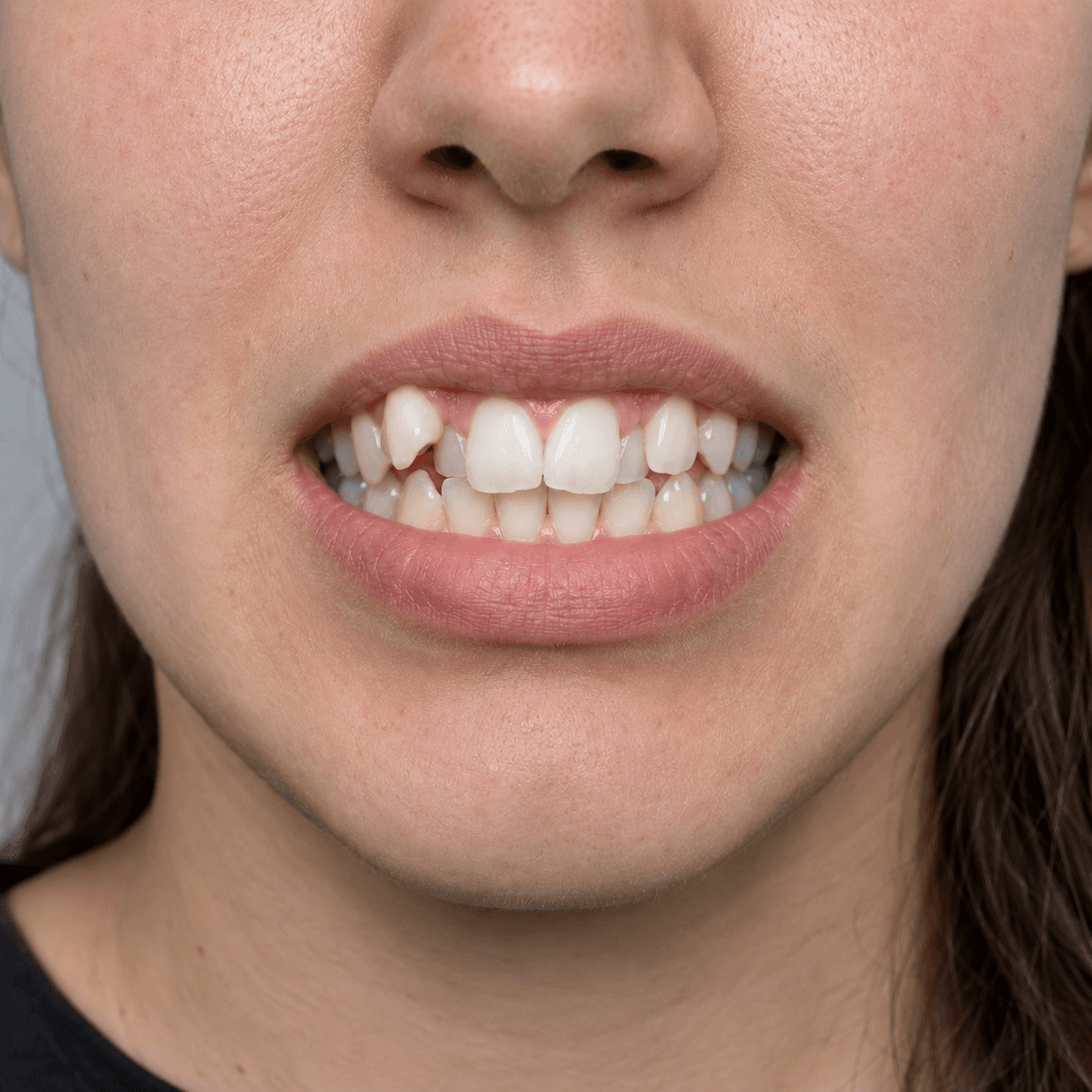 Ortodoncia e Invisalign — antes