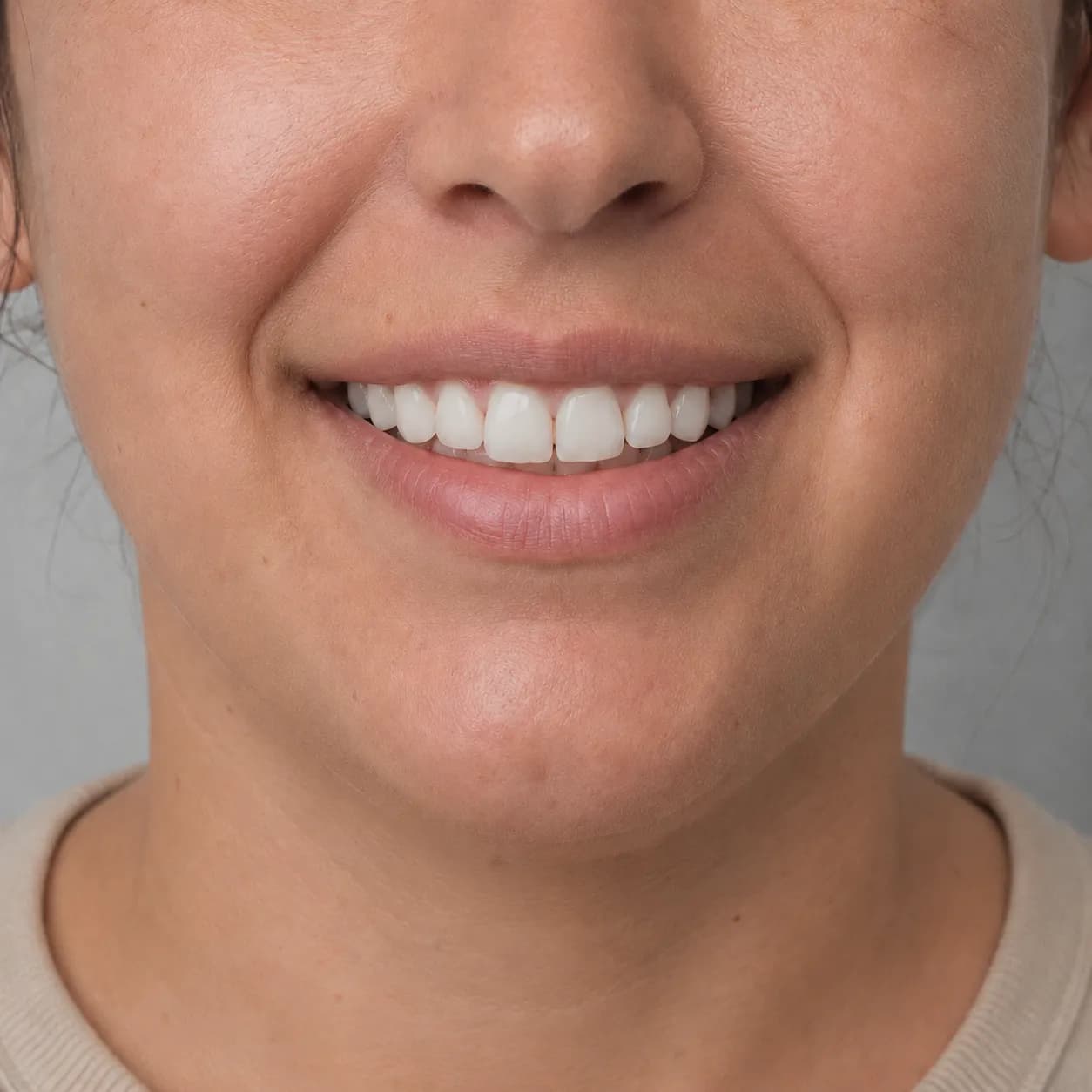 Estética dental — después