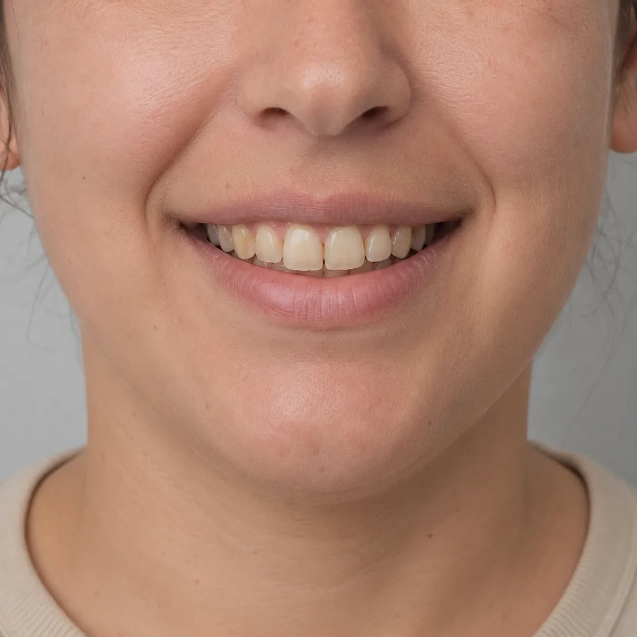 Estética dental — antes